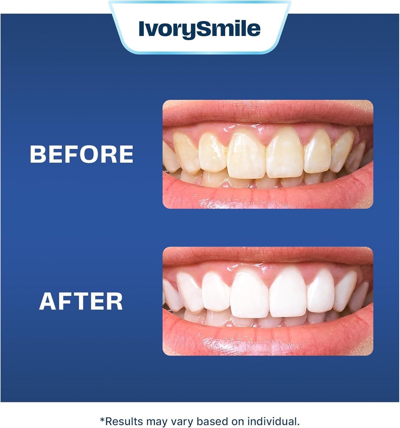 Premium Teeth Whitening Strips - Non-Sensitive Formula - Enamel Safe - 40 Peroxide-Free Whitening Strips - 20 Treatments - Dentist Formulated Teeth Whitening Kit, Mouth Opener Included