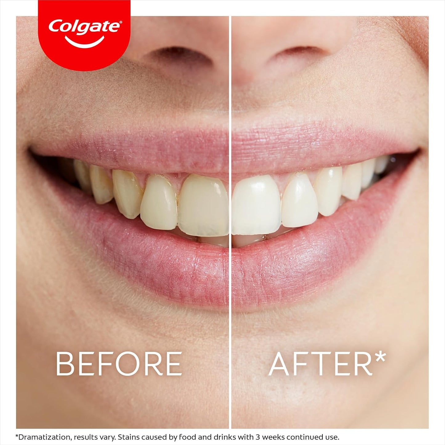Max White Ultimate Overnight Teeth Whitening Pen, Reverses 15 Years of Stains* 2.5Ml, 1 Pack, 35 Nightly Treatments